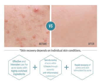 Pyunkang Yull Acne Spot Cream result after using