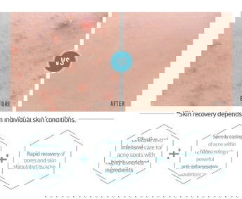 Pyunkang Yull Acne Spot Cream - LB BEAUTY 